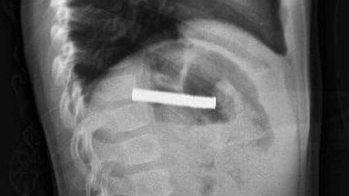 elazigda cocugun bogazindan 19 adet miknatis cikartildi UM4wcdvJ